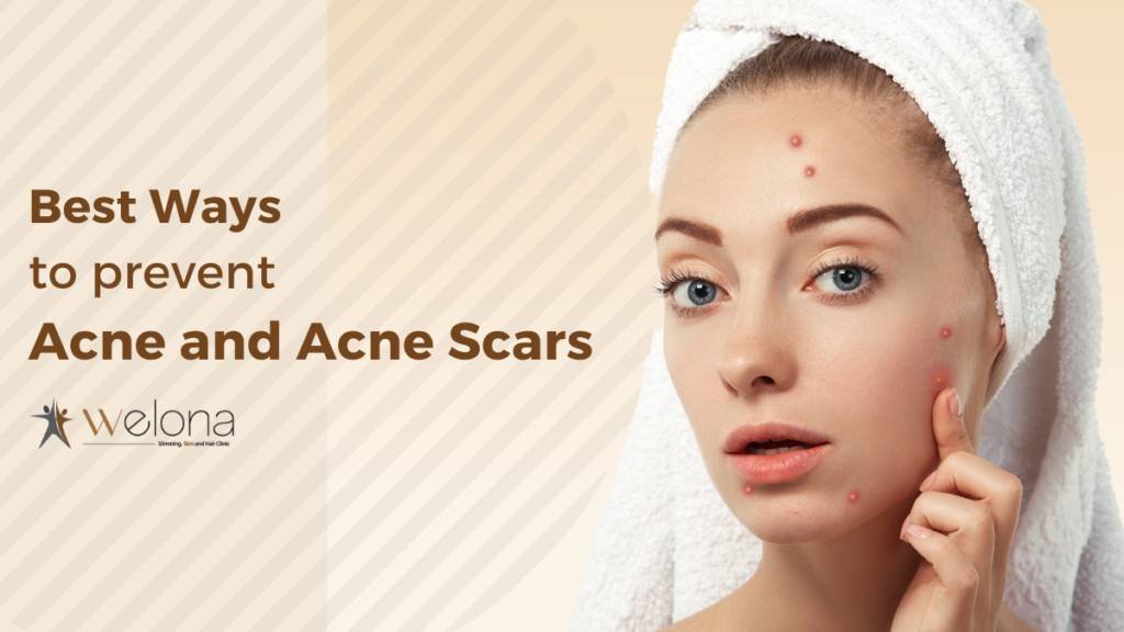 Prevent Acne and Acne scars