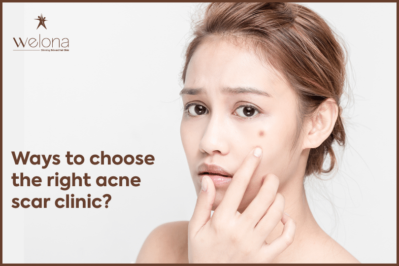 acne scar clinic Chennai
