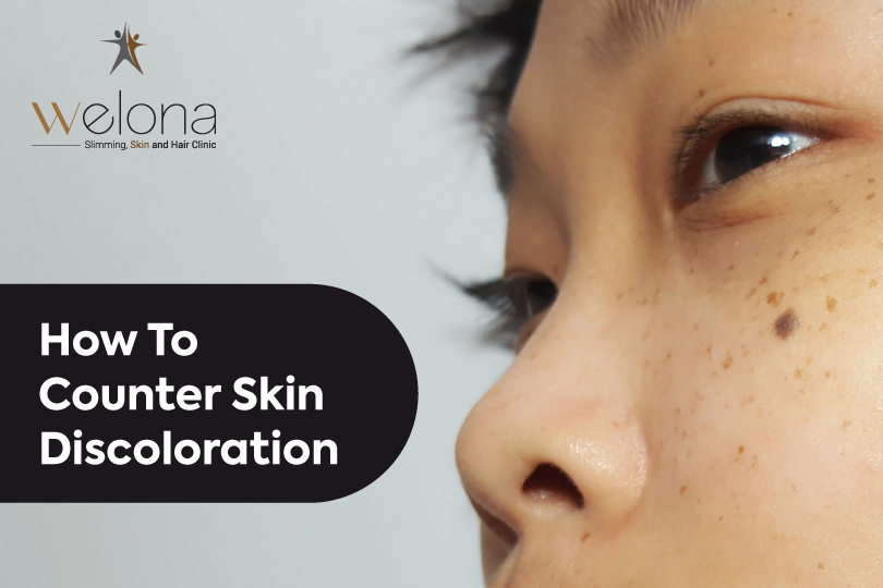Causes of Skin Pigmentation
