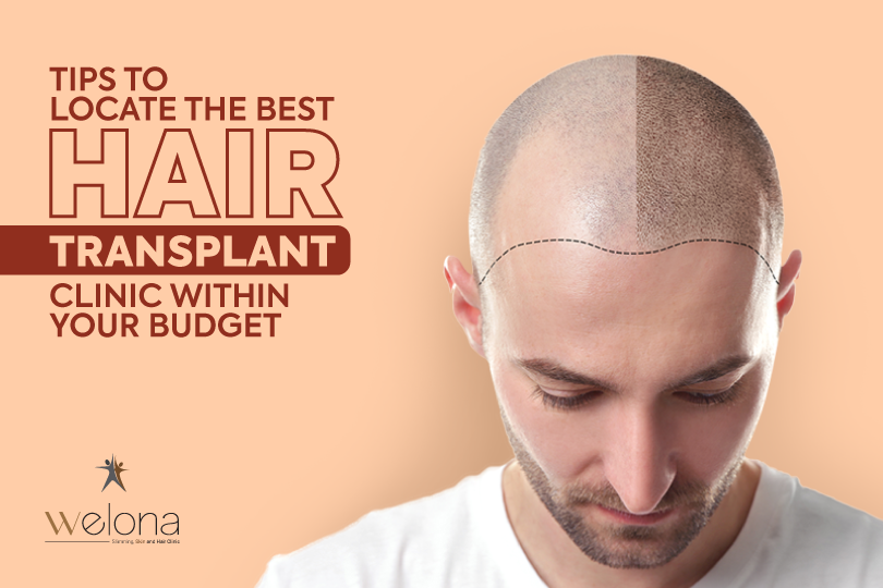 Tips to Locate the Best Hair Transplant Clinic within Your Budget