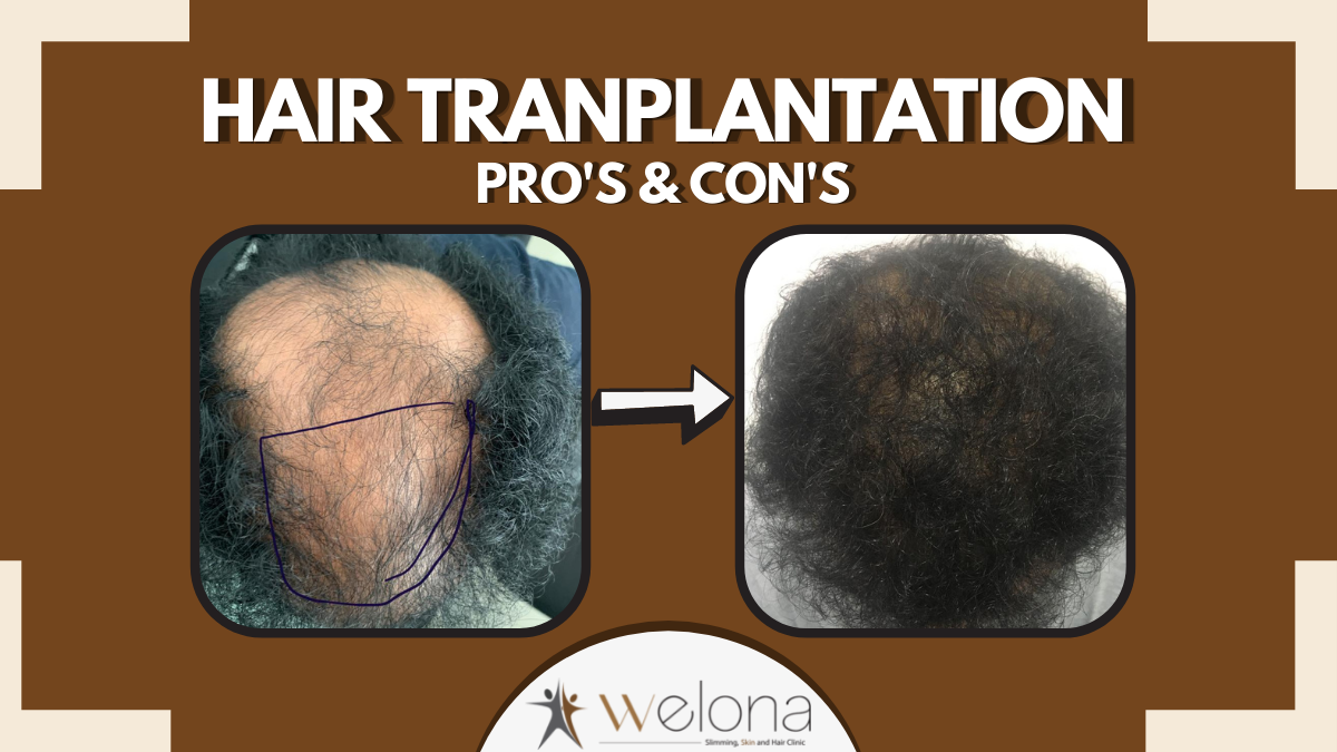 Hair Transplantation benefits