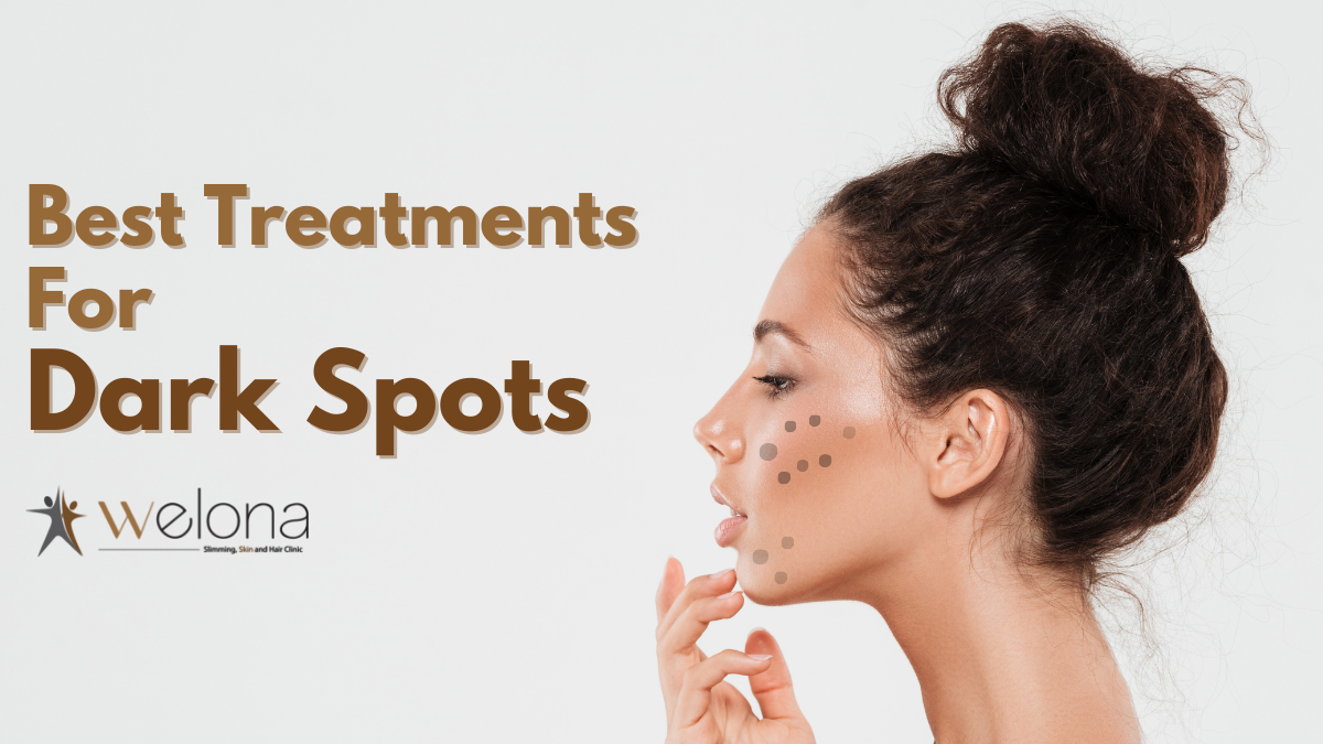 Dark Spots – What Are the Available Treatment Methods