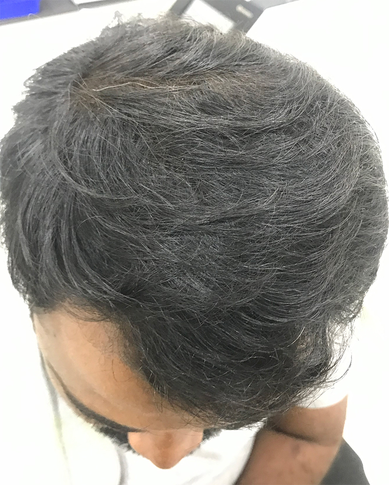 PRP Hair Loss Treatment in Chennai at an Effective Cost - Welona
