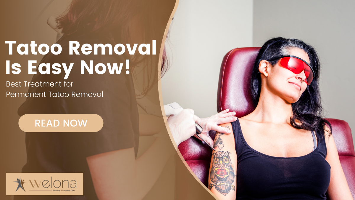 All You Need To Know About Laser Tattoo Removal