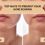 best acne scar treatment in chennai