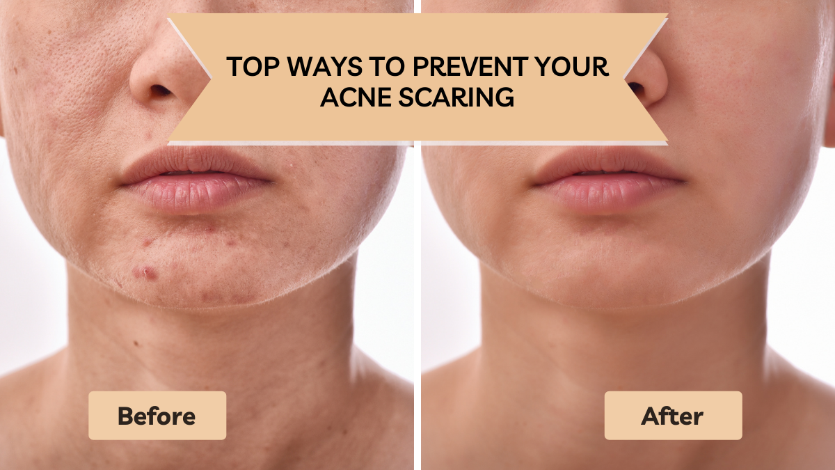 Top Ways to Prevent Acne Scarring