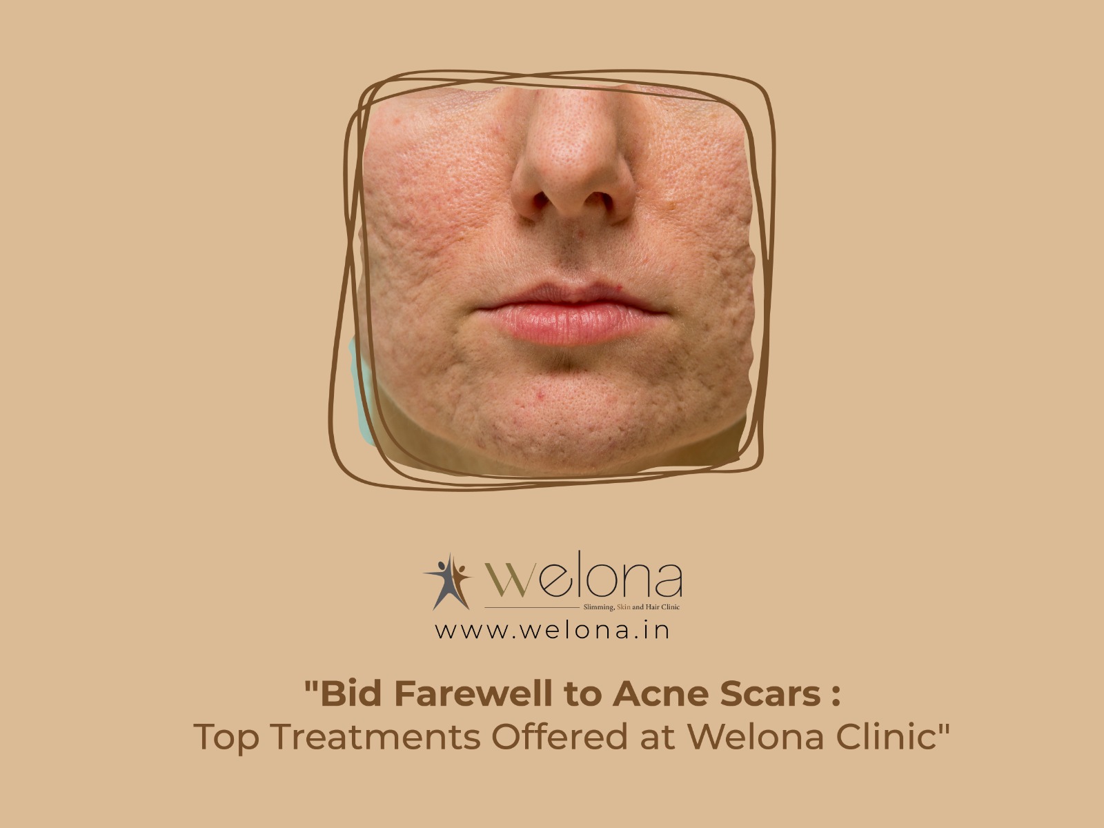 Bid Farewell to Acne Scars: Top Treatments Offered at Welona Clinic