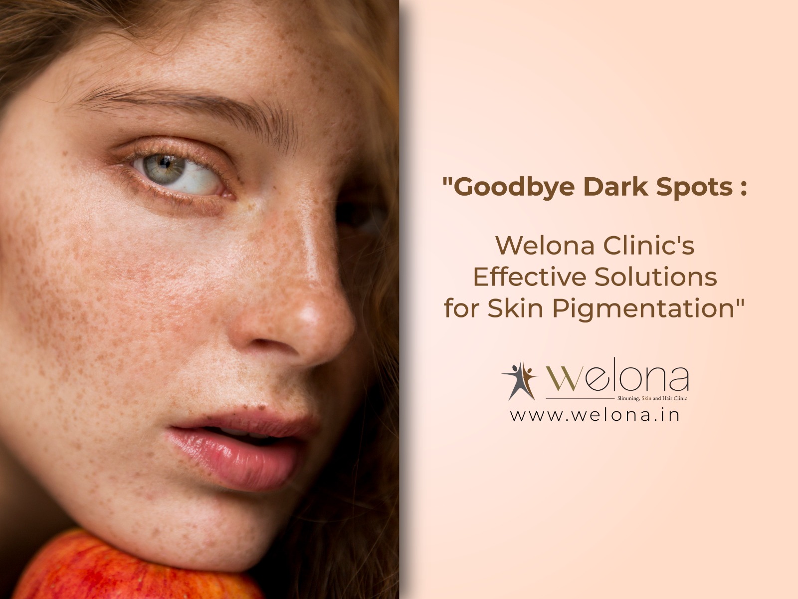 Dark Spots: Welona Clinic’s Effective Solutions for Skin Pigmentation