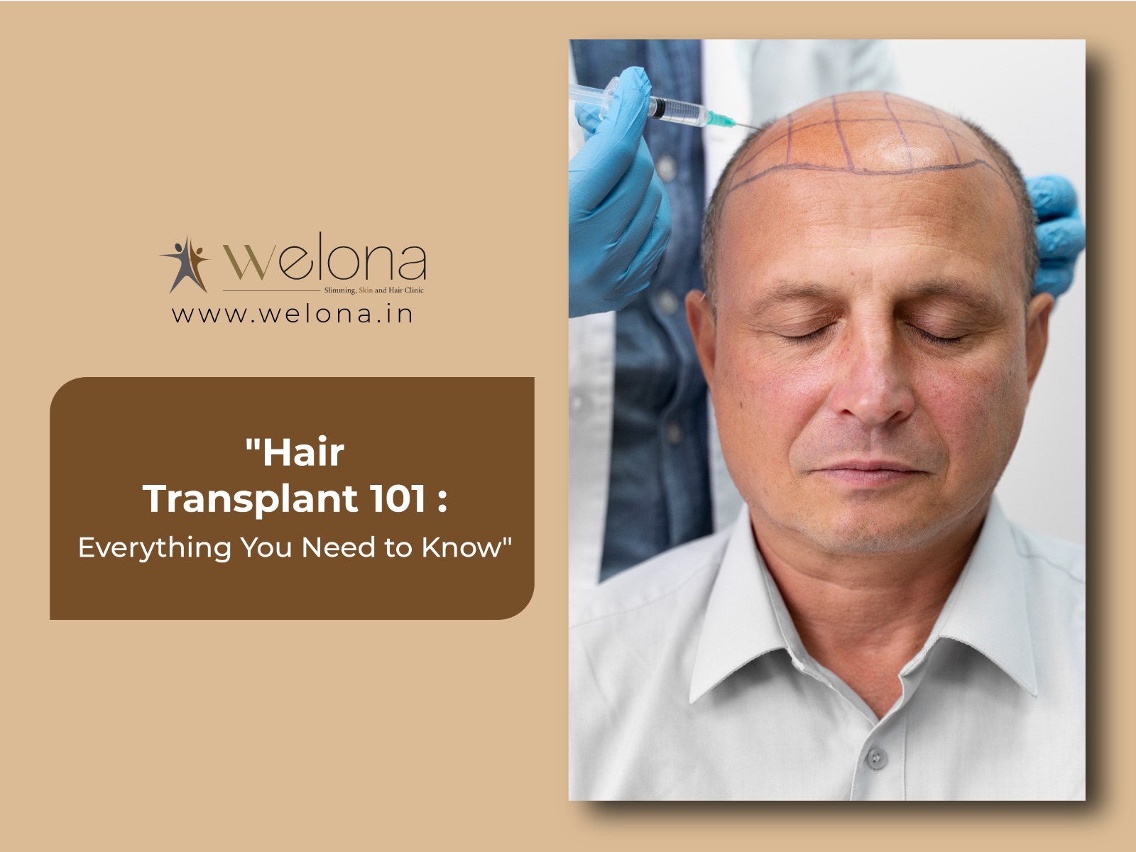 Hair Transplant 101: Everything You Need to Know