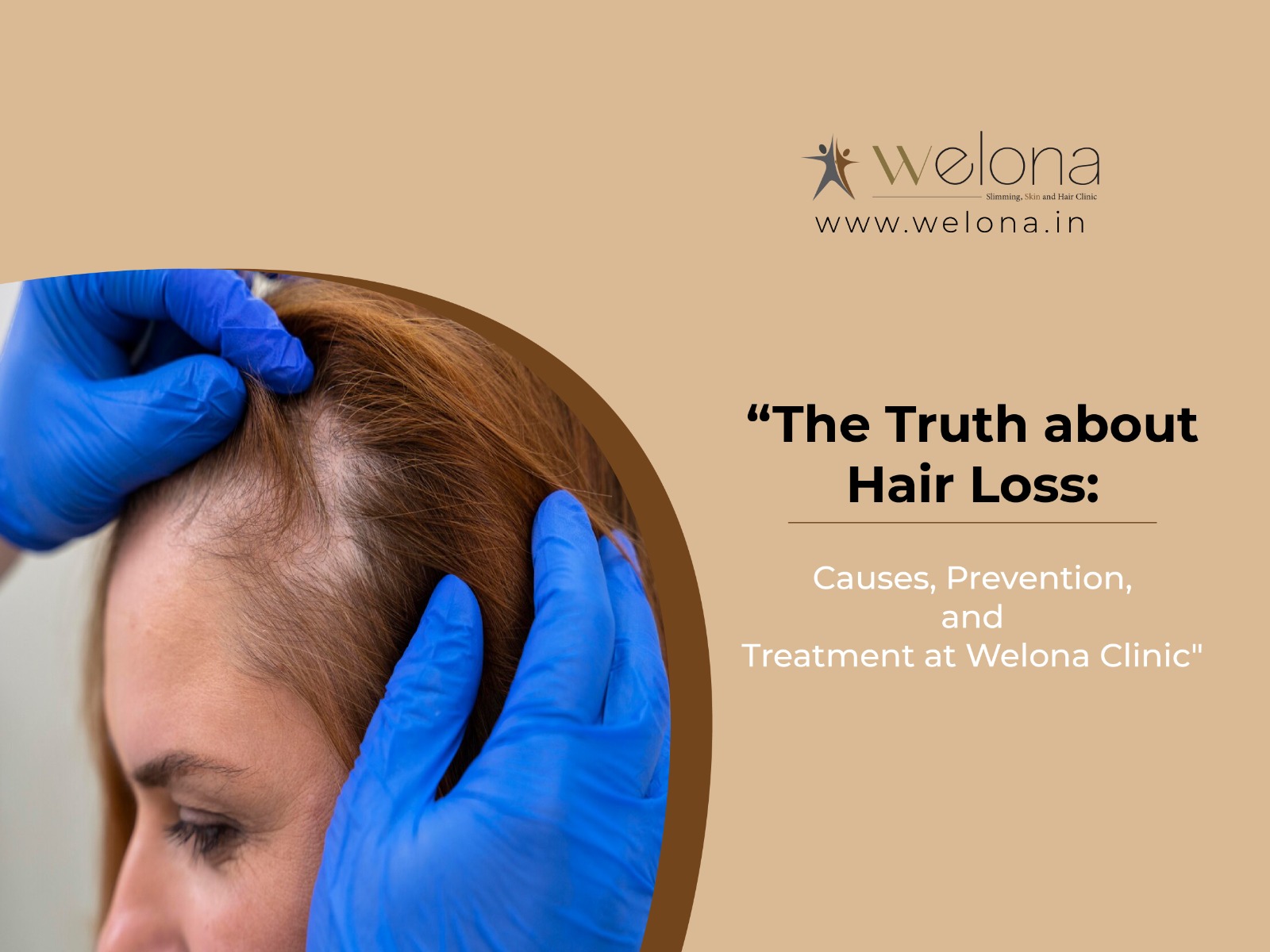 The Truth about Hair Loss: Causes, Prevention, and Treatment at Welona Clinic
