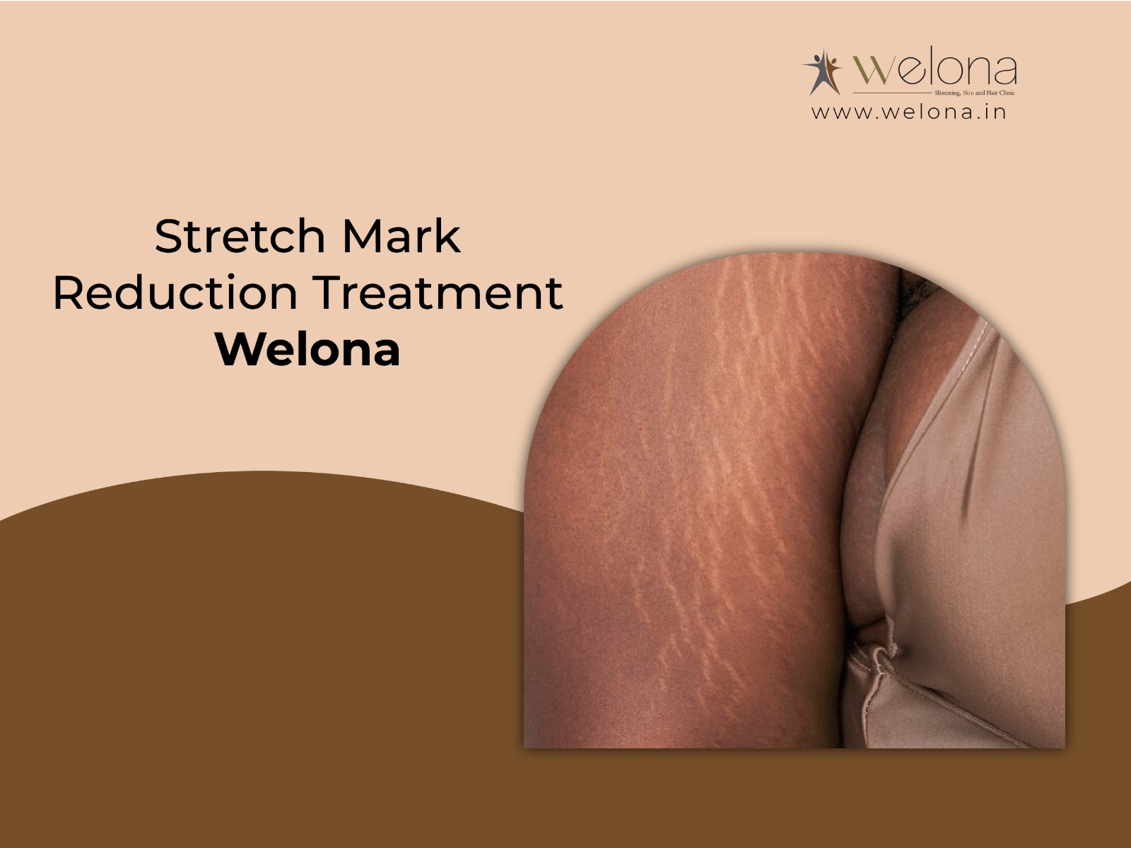 Stretch Marks Reduction Treatment From Welona