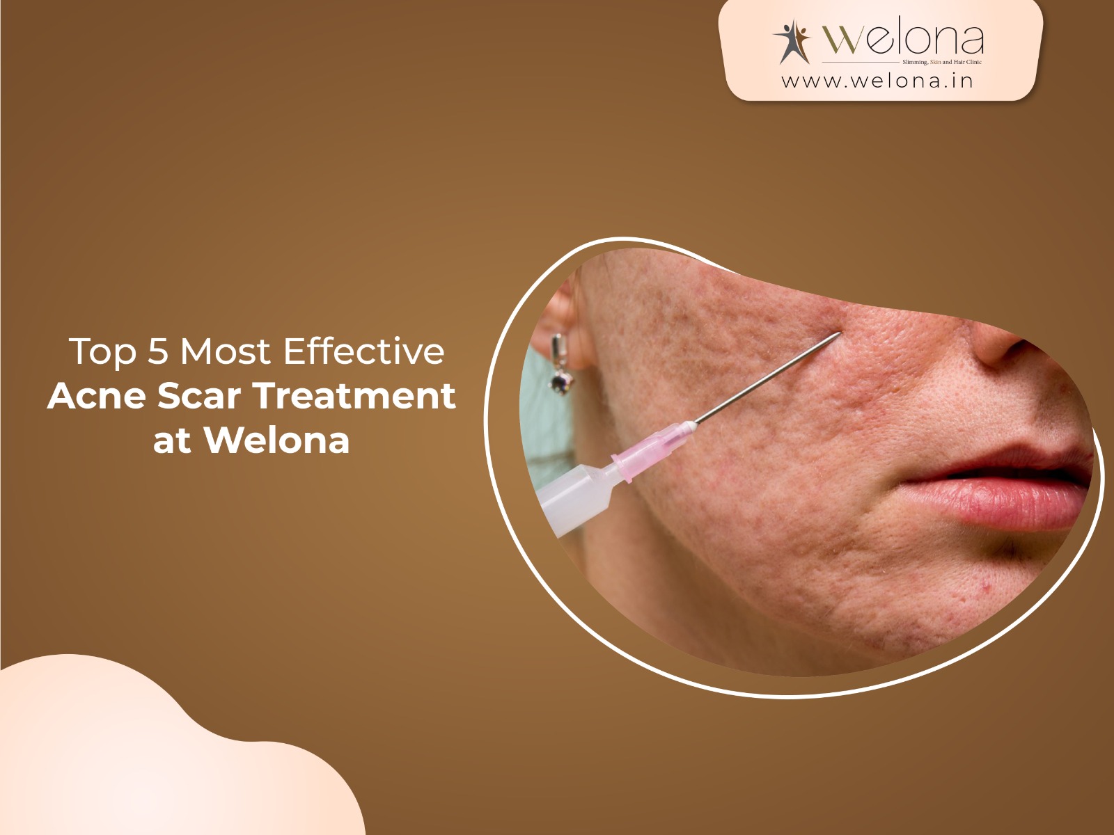 Top 5 Most Effective Acne Scar Treatments at Welona