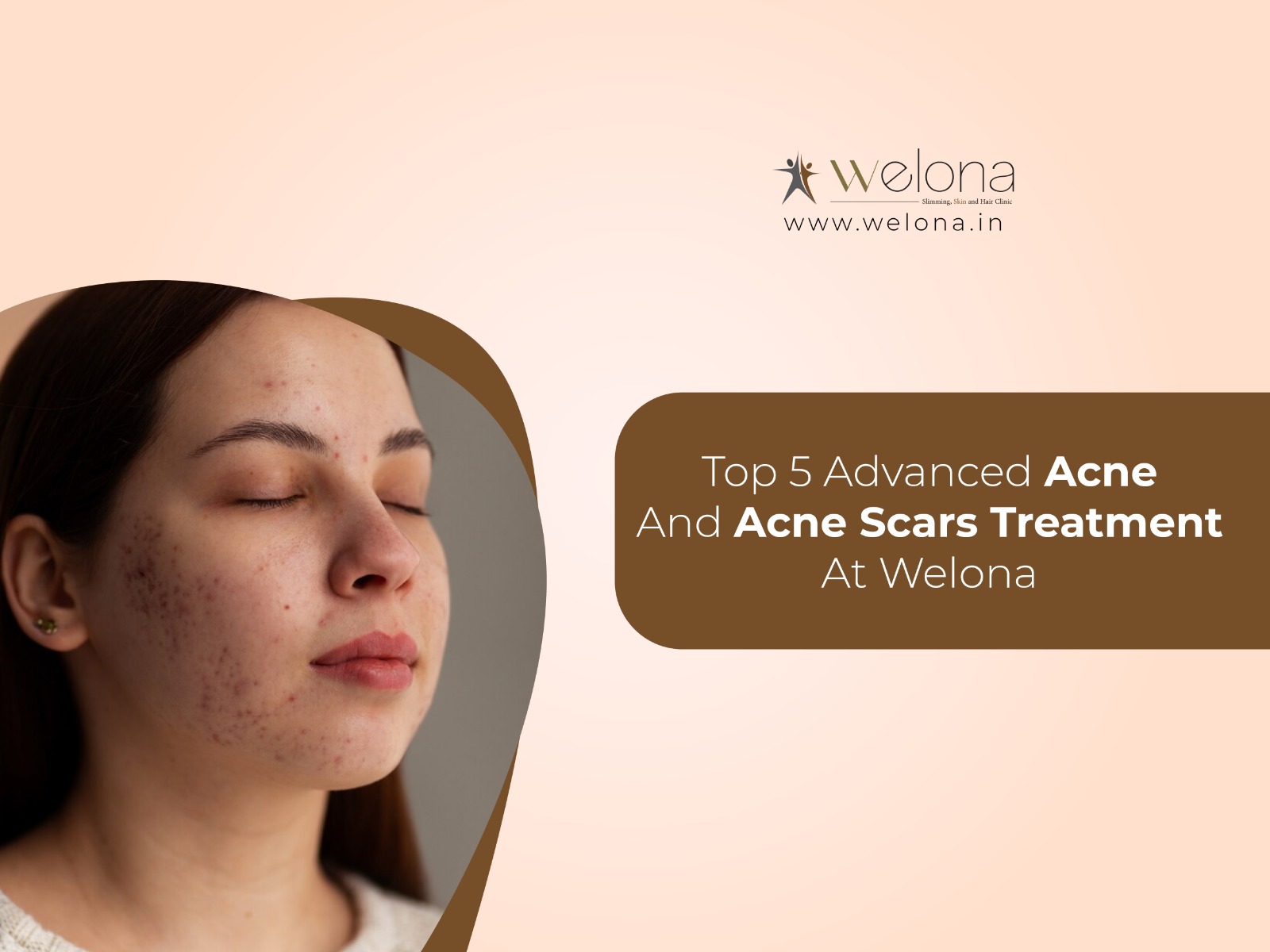 Top 5 Advanced Acne And Acne Scar Treatment At Welona