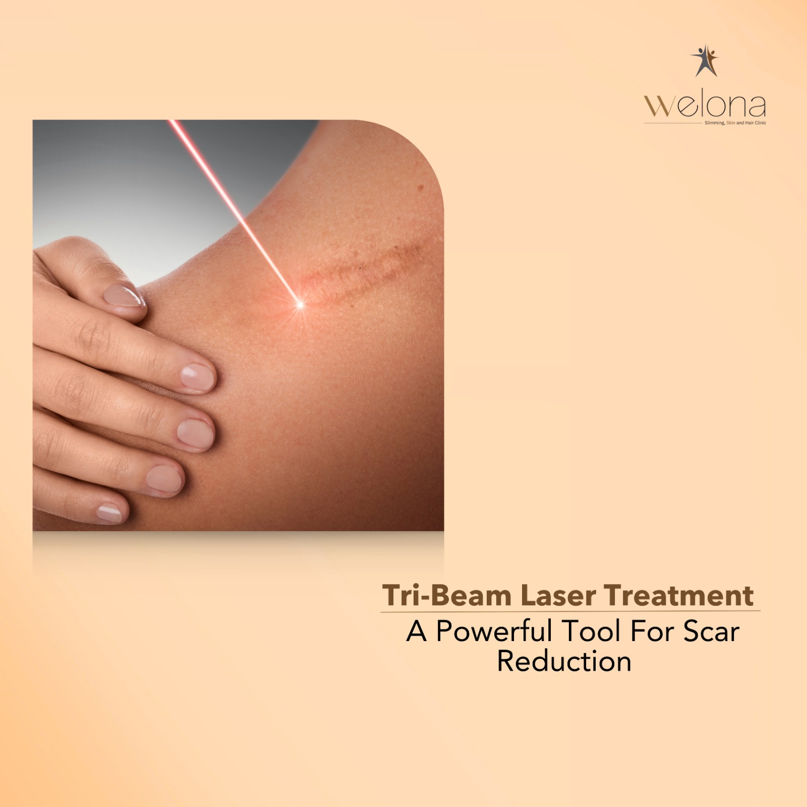 Welona’s Tri-Beam Laser Treatment – A Powerful Tool For Scar Reduction