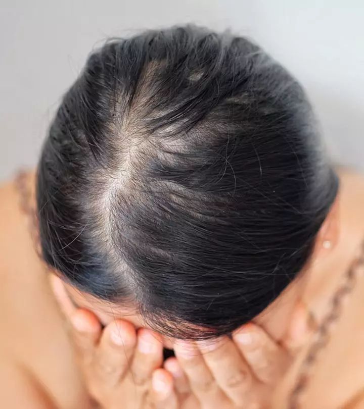 How to Prevent and Manage Hair Loss image 2