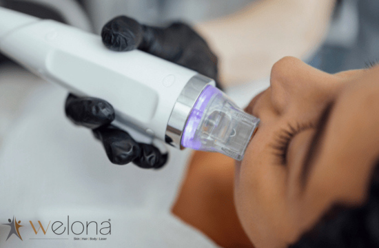 MNRF-treatment for acne scars