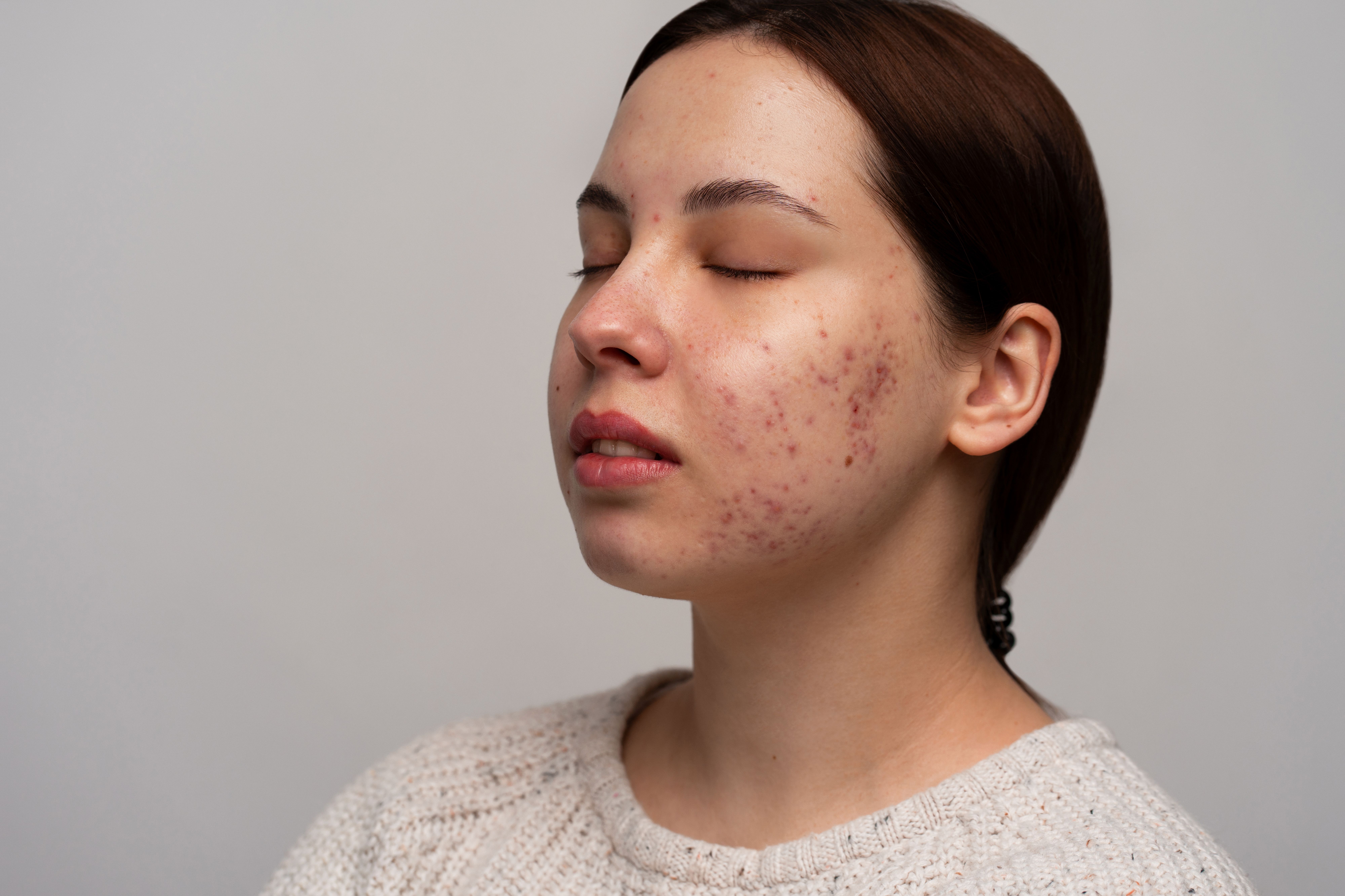 acne scars