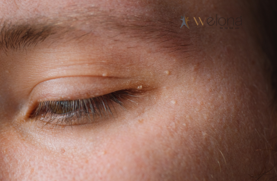 Wondering why milia won't go away? Learn what causes these tiny white bumps, how they differ from acne, and the safest dermatologist-recommended treatment options.
